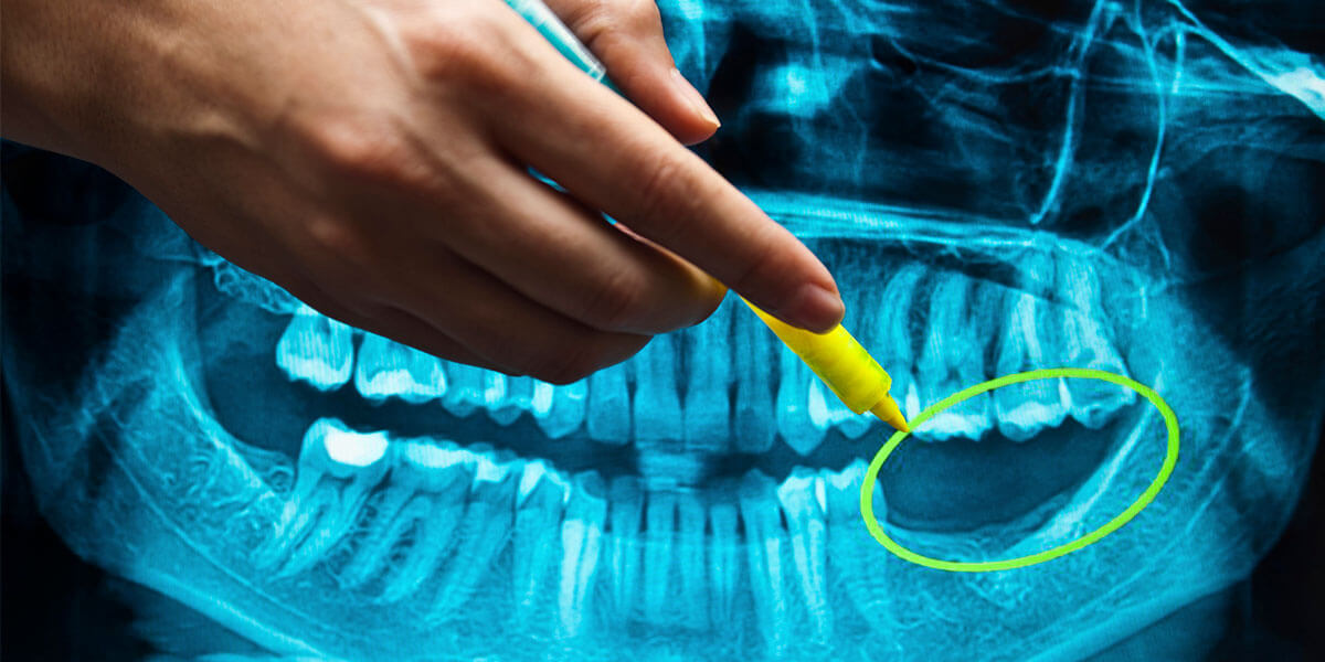 Xray showing missing teeth